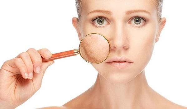Lý giải nguyên nhân phụ nữ bị nám da nhiều hơn nam giới và cách hỗ trợ cải thiện