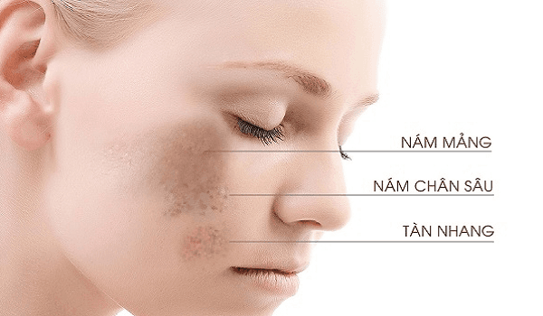 Bí kíp skincare xóa tan nỗi lo tàn nhang, thâm nám và đốm nâu