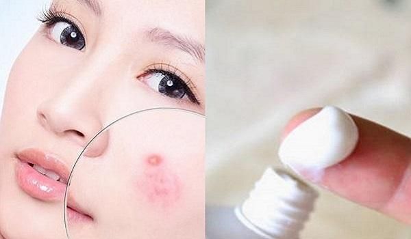 Review các loại kem hỗ trợ làm sạch mụn cao cấp được bác sĩ và chuyên gia da liễu khuyên dùng