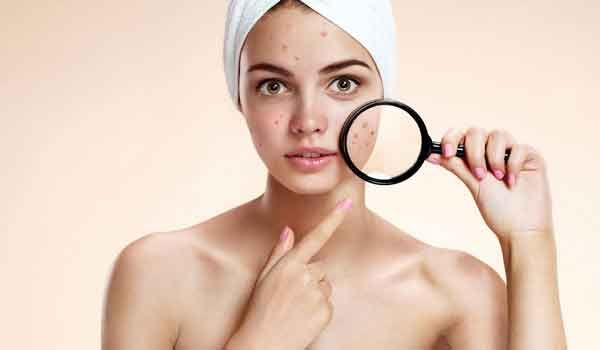 Nguyên tắc chăm sóc da mụn tại nhà thân thiện với làn da, hiệu quả sau 1 tuần