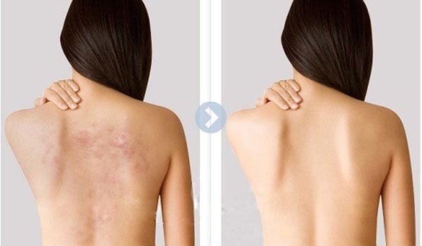 10 cách hỗ trợ làm sạch mụn lưng hiệu quả tại nhà và các loại sữa tắm giảm mụn dưỡng da được nhiều khách hàng yêu thích