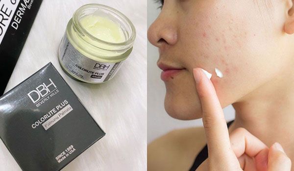 Review 6 kem hỗ trợ làm sạch mụn cho da khô chất lượng tốt mọi thời đại