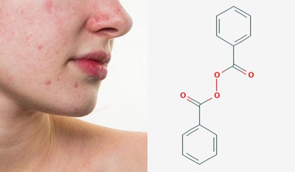 Benzoyl Peroxide là gì? Dùng Benzoyl Peroxide hỗ trợ làm sạch mụn có thực sự tốt hay không?