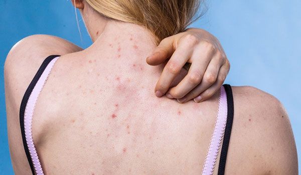 12 cách chữa viêm nang lông nhẹ tại nhà hiệu quả và tiết kiệm