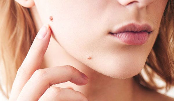 13 phương pháp hỗ trợ làm sạch mụn cóc hiệu quả và thân thiện với làn da