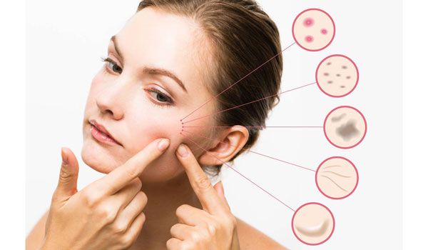 Top 11 cách hỗ trợ làm sạch mụn đầu đen cứng đầu ở má hiệu quả