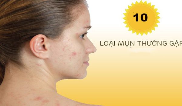 10 cách nhận diện các loại mụn trên khuôn mặt bạn nên biết