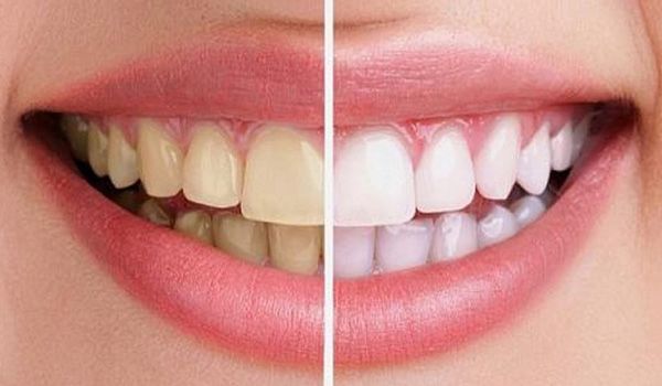12 cách làm trắng răng bị ố vàng hiệu quả tức thì thân thiện với làn da tại nhà