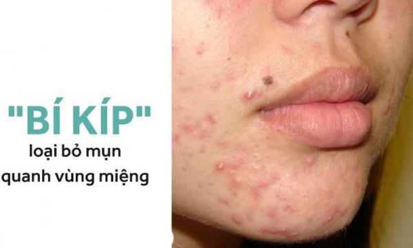 Top 6 cách hỗ trợ cải thiện mụn mọc quanh miệng giúp cải thiện đáng kể điểm nhanh chóng