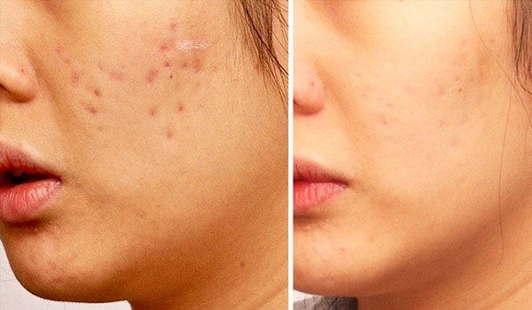 12 cách làm mờ sẹo thủy đậu thân thiện với làn da và rất nhanh chóng