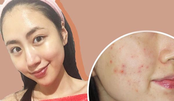 12 cách hỗ trợ làm sạch mụn đỏ, giảm mụn sưng đỏ nhanh chóng cấp tốc