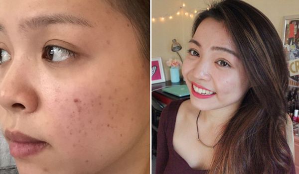 Thâm mụn bao lâu thì hết? Chọn kem trị hết thâm mụn trong 1 tuần