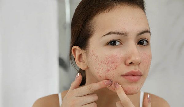 Nguyên nhân và cách hỗ trợ cải thiện mụn ở cằm hiệu quả nhanh chóng
