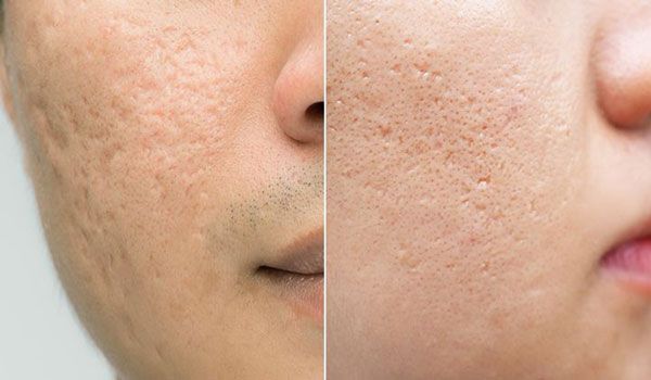 15 Cách trị sẹo rỗ do mụn hiệu quả và thân thiện với làn da hiện nay
