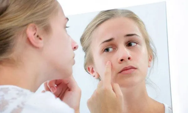 Mụn đầu trắng là gì? Nguyên nhân và cách hỗ trợ làm sạch mụn đầu trắng tại nhà hiệu quả