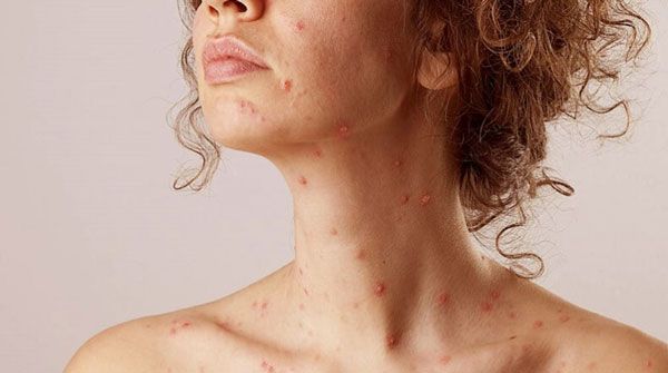 10 cách chăm sóc da sau khi bị thủy đậu nhanh cải thiện, không sẹo