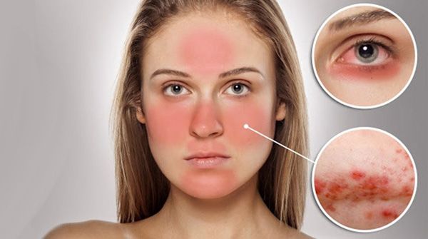 Cách chăm sóc da bị dị ứng mỹ phẩm giúp da nhanh lành hiệu quả
