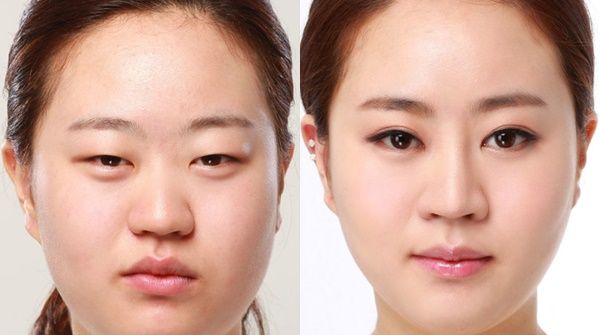 Top 10 cách chữa sụp mí mắt tại nhà hiệu quả tốc độ vượt trội