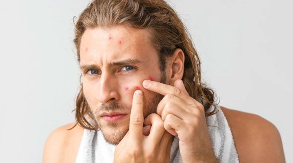 9 cách chăm sóc da mụn cho nam hiệu quả nhanh chóng