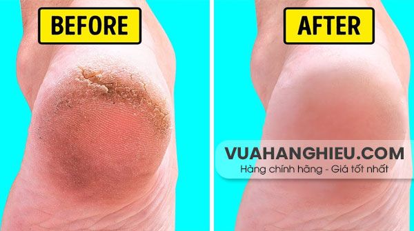 11 Cách trị nứt gót chân từ thiên nhiên hiệu quả tại nhà
