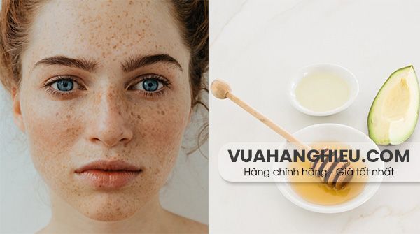 12 cách trị tàn nhang từ thiên nhiên hiệu quả tại nhà