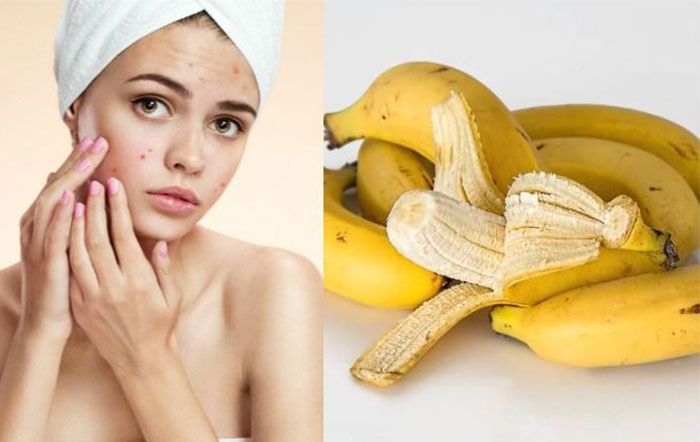 7 cách dùng vỏ chuối để hỗ trợ làm sạch mụn và thâm sẹo hiệu quả