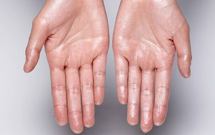 Nguyên nhân và 9 cách ngăn ngừa đồ mồ hôi tay hiệu quả