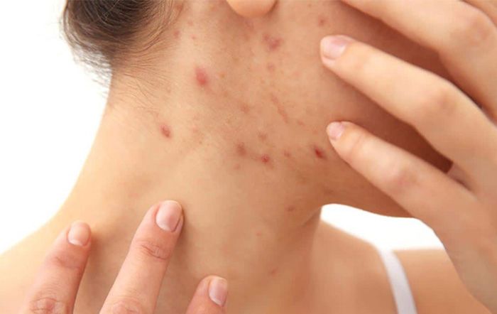Cách hỗ trợ làm sạch mụn khi mang thai thân thiện với làn da và hiệu quả được bác sĩ khuyên dùng