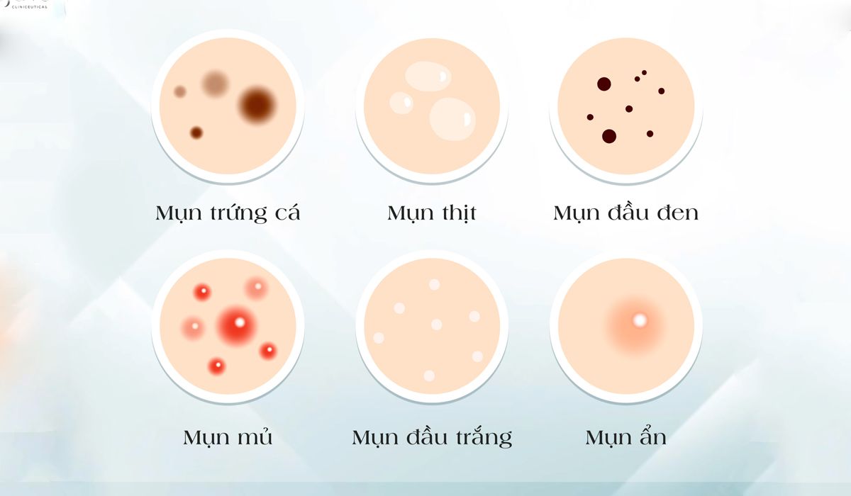 Cách phân biệt các loại mụn dễ bắt gặp trên da