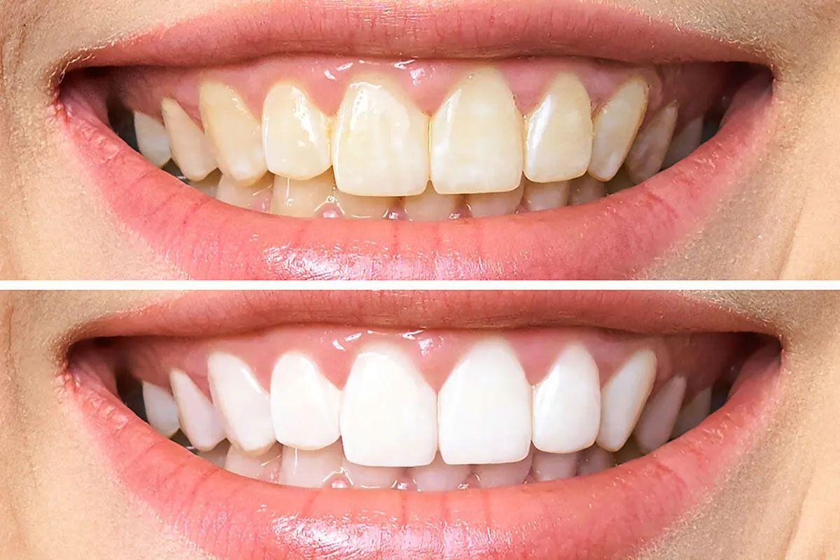 13 cách làm trắng răng tại nhà thân thiện với làn da, siêu tiết kiệm