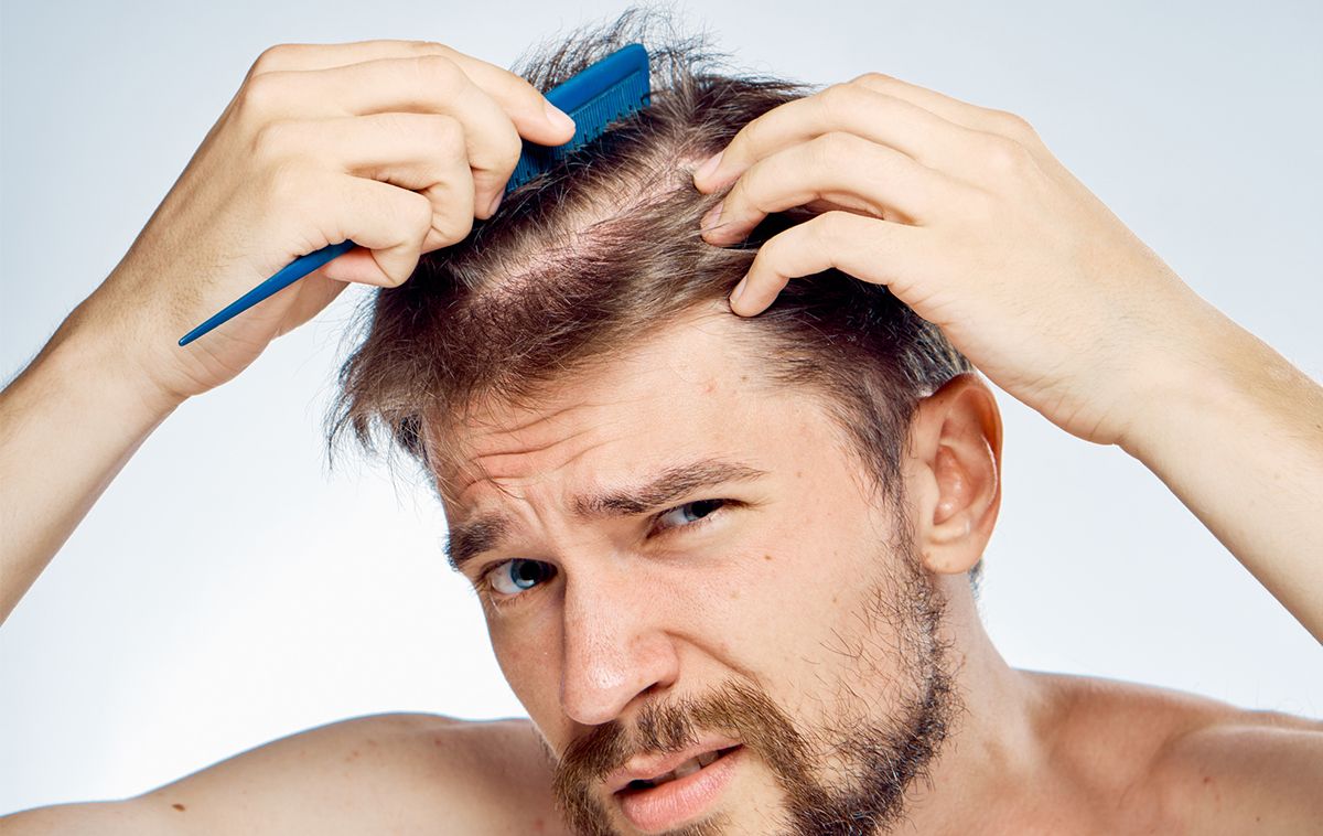 Nguyên nhân rụng tóc ở nam giới và 9 cách khắc phục hiệu quả