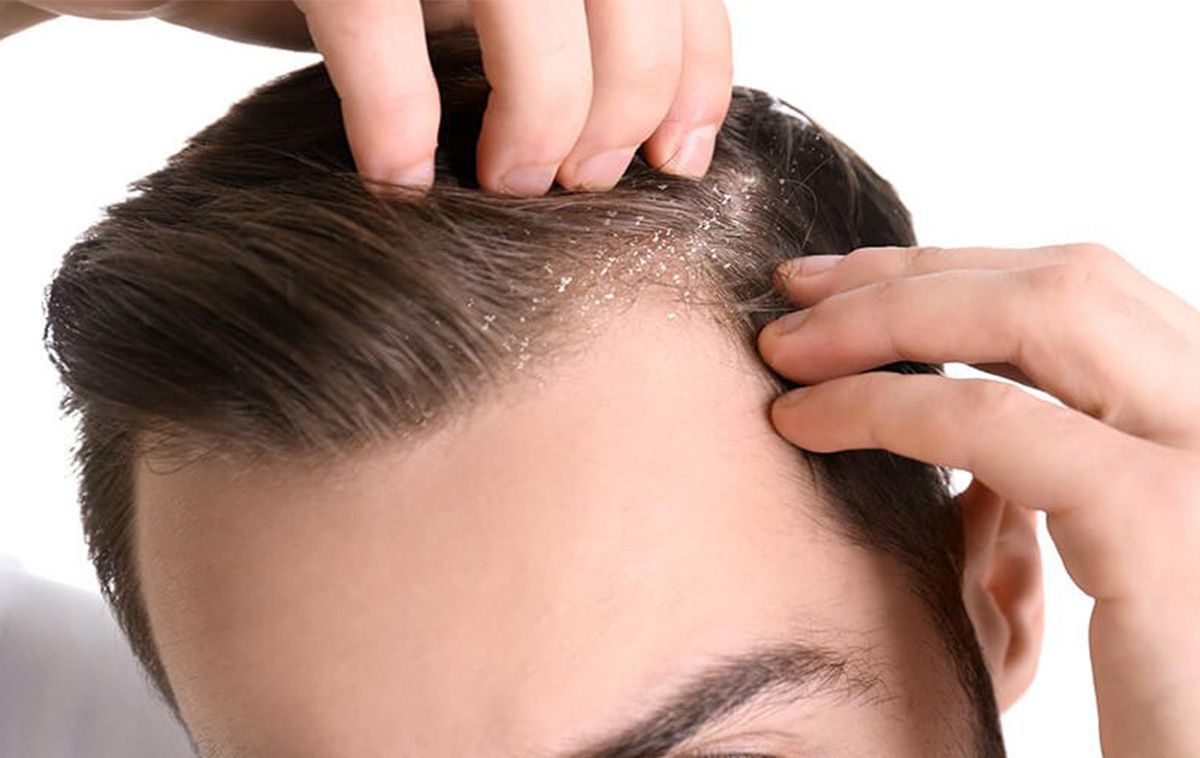 Top 10 dầu gội trị gàu cho nam hiệu quả được đánh giá cao
