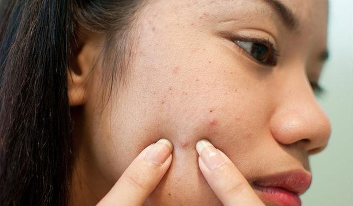 Không nặn mụn có tự hết không? Hướng dẫn cách tự nặn mụn an toàn