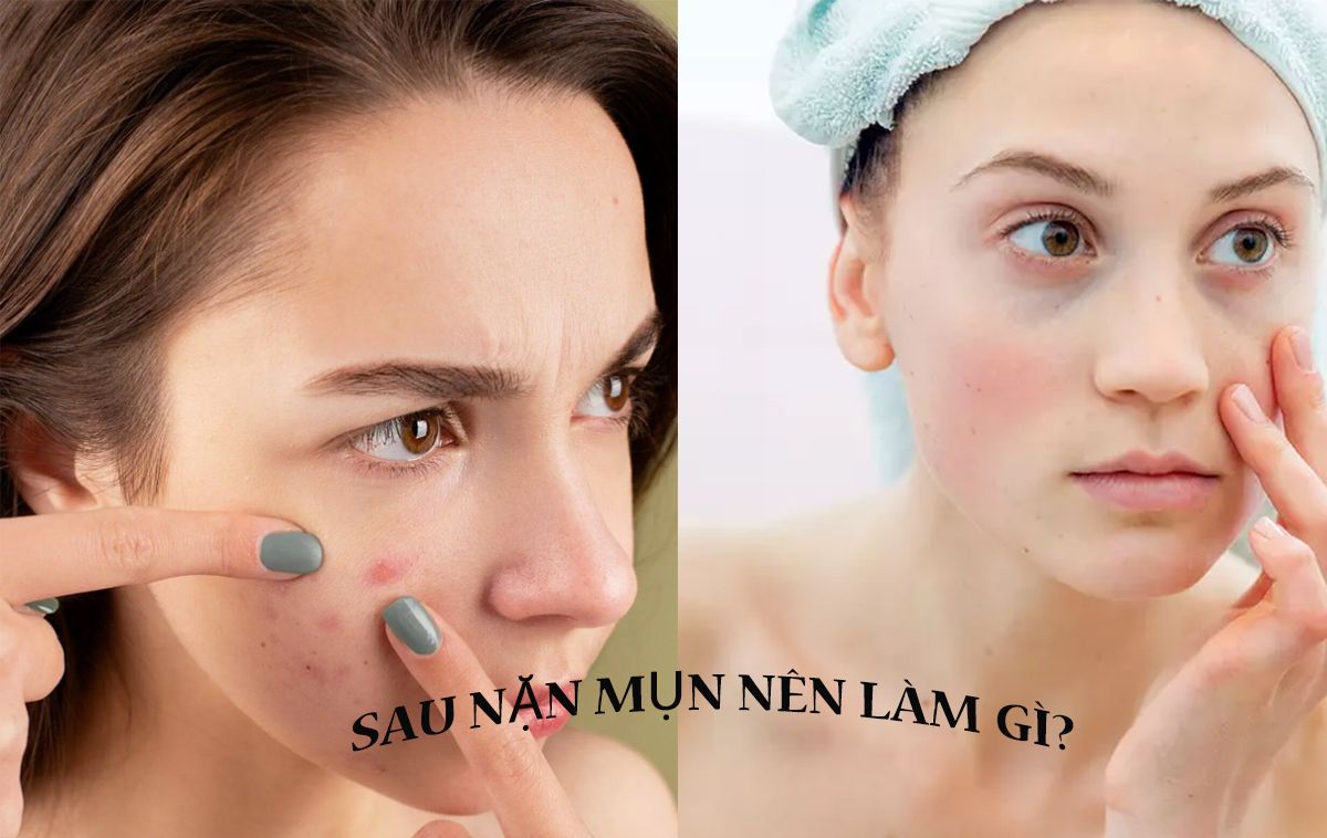 Nặn mụn xong nên làm gì? Hướng dẫn các bước chăm sóc da sau nặn mụn uy tín