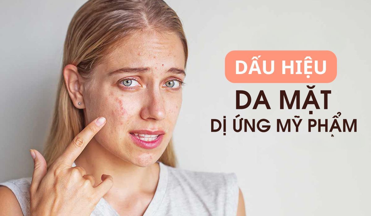 Dấu hiệu dị ứng mỹ phẩm bạn nổi trội định phải chú ý