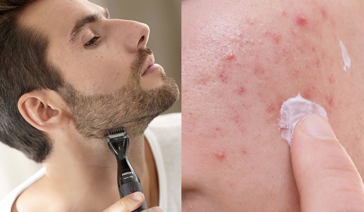 Tại sao cạo râu bị nổi mụn? 10 điều nên tránh khi cạo râu