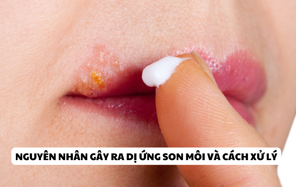 Tìm hiểu về dị ứng son môi và cách xử lý hiệu quả