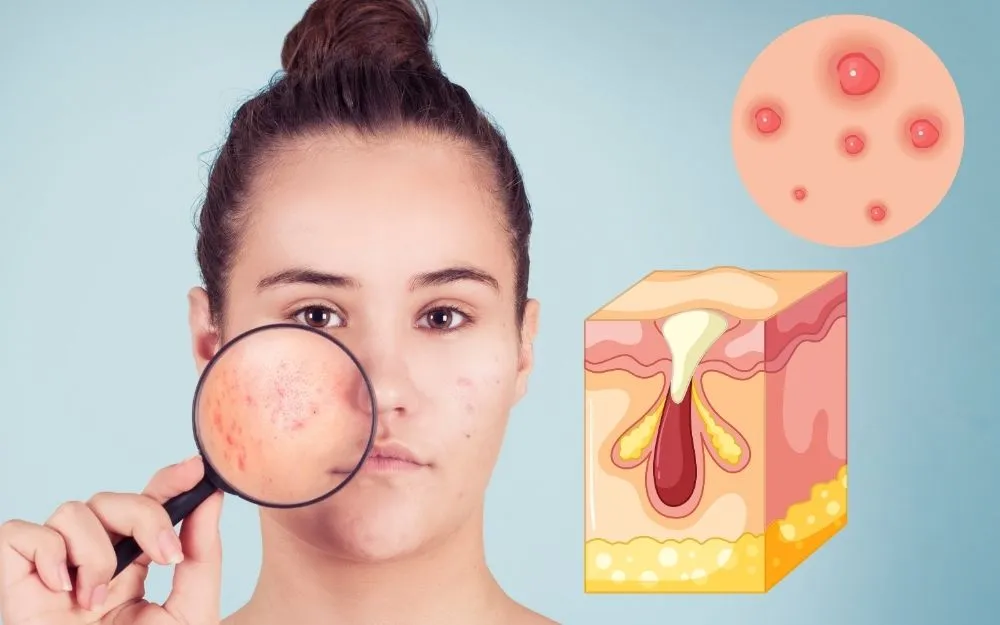 Mụn Bọc: Đặc Điểm, Nguyên Nhân Và Cách Khắc Phục Hiệu Quả