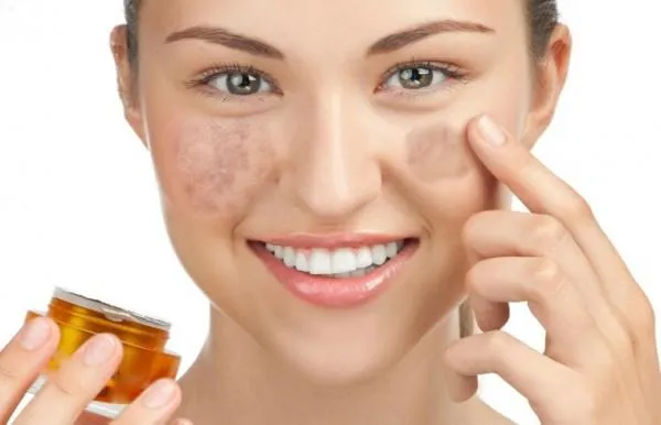 Lý giải nguyên nhân phụ nữ bị nám da nhiều hơn nam giới và cách hỗ trợ cải thiện