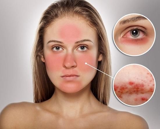 30+ loại kem dưỡng ẩm cho da nhạy cảm thân thiện với làn da và hiệu quả