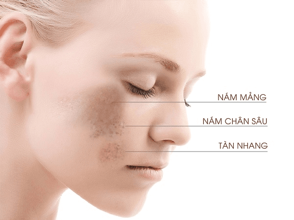 Bí kíp skincare xóa tan nỗi lo tàn nhang, thâm nám và đốm nâu