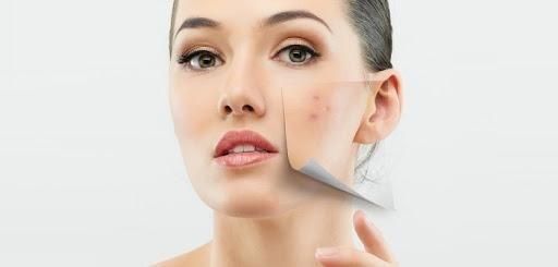 Trị thâm mụn có khó? Nỗi lo hay ám ảnh của các cô gái?