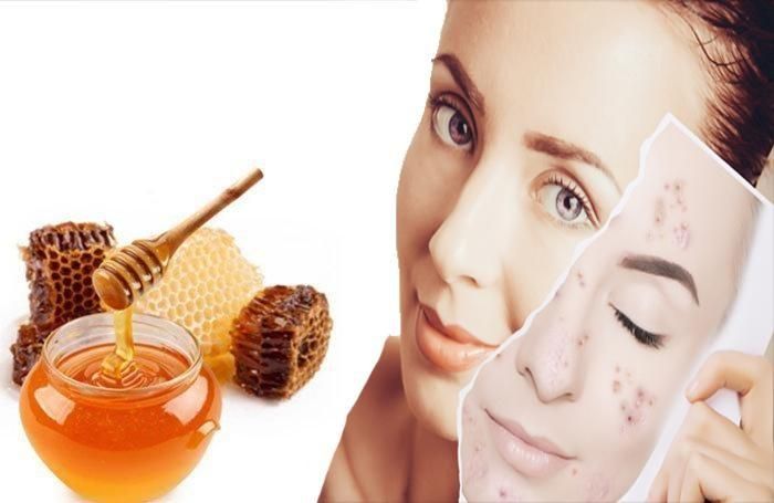 Trị thâm mụn có khó? Nỗi lo hay ám ảnh của các cô gái?
