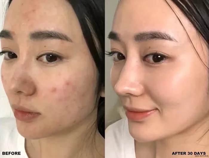 BHA là gì? Công dụng và cách dùng mỹ phẩm BHA hiệu quả