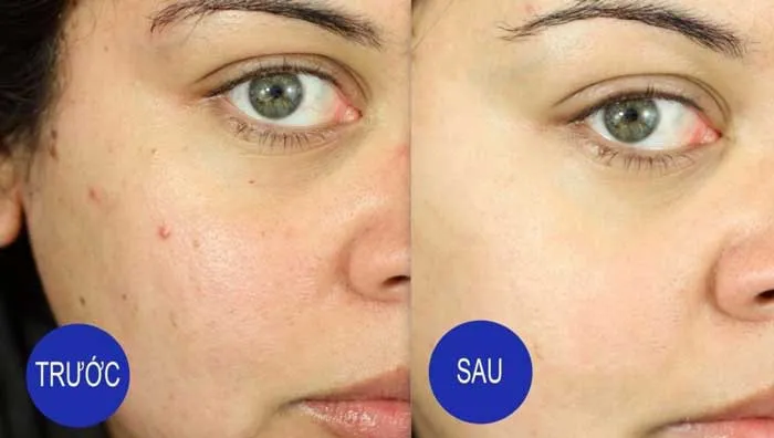 Review 7 mỹ phẩm Obagi ngăn ngừa mụn chất lượng tốt bán chạy tại Mỹ