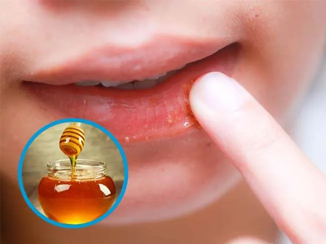 11 cách trị thâm môi hiệu quả nhanh chóng tiết kiệm tại nhà
