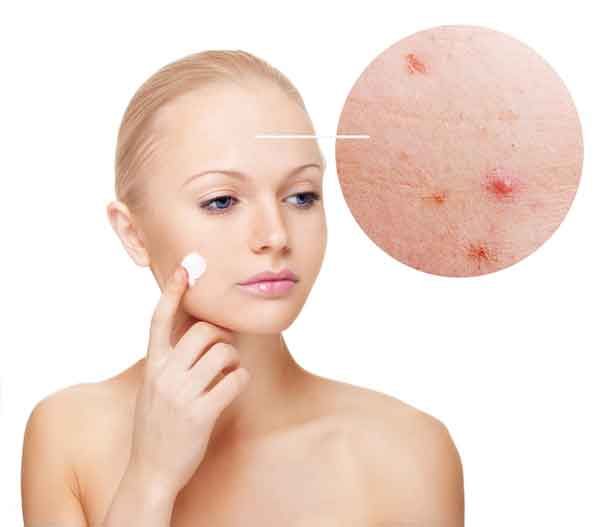 Nguyên tắc chăm sóc da mụn tại nhà thân thiện với làn da, hiệu quả sau 1 tuần