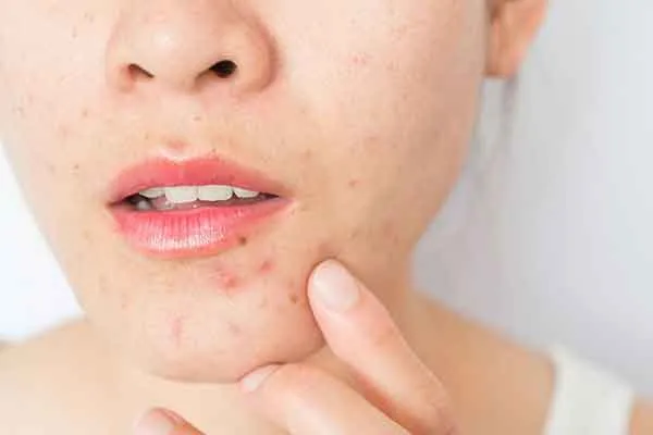Mụn ẩn là gì? Review 7 sản phẩm hỗ trợ làm sạch mụn ẩn tại nhà rất triệt để