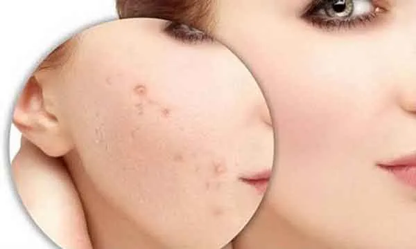 Mụn ẩn là gì? Review 7 sản phẩm hỗ trợ làm sạch mụn ẩn tại nhà rất triệt để