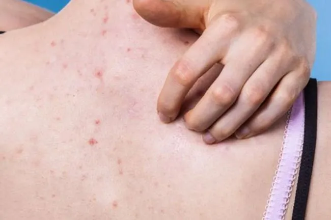 10 cách hỗ trợ làm sạch mụn lưng hiệu quả tại nhà và các loại sữa tắm giảm mụn dưỡng da được nhiều khách hàng yêu thích